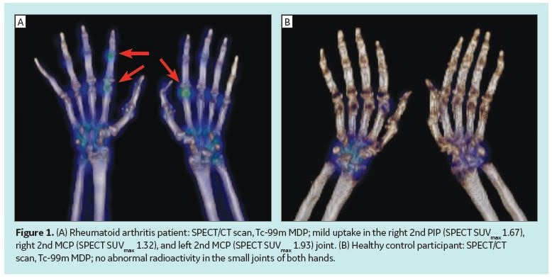 https://www.gehealthcare.com/-/jssmedia/images/clarity/spect/spect-ct-may-help-to-evaluate-arthritic/fig_02_cc.jpg?rev=-1&hash=F155A4BA32B9DCA7F14B92E7ABFB827E