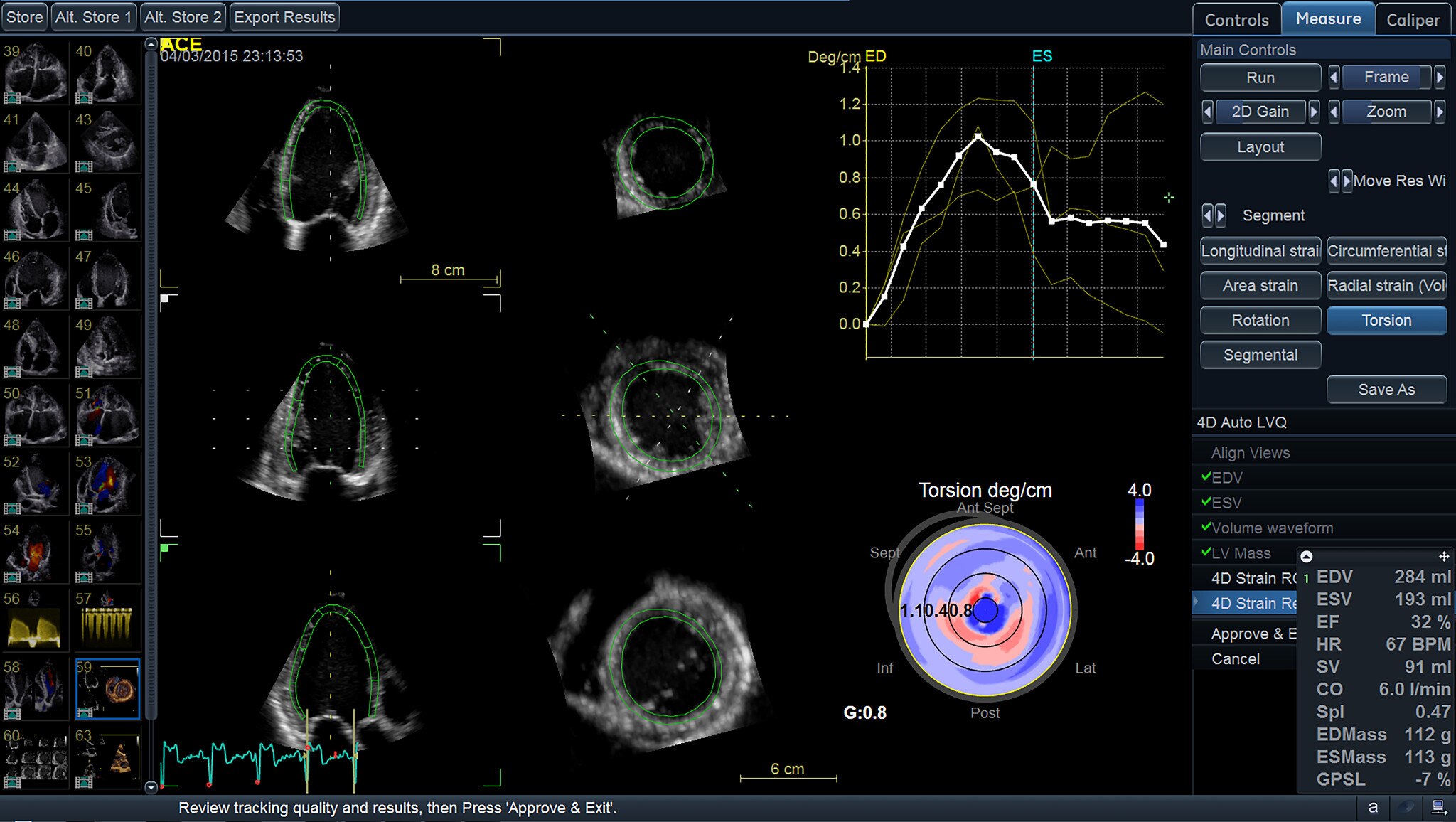 ViewPoint 6 and EchoPAC Suite for Cardiology | GE Healthcare