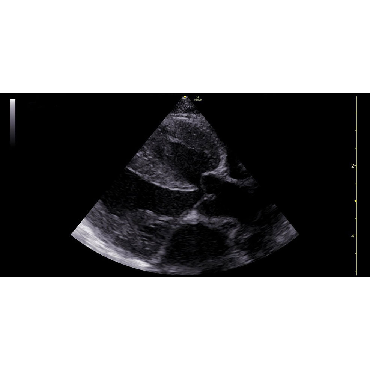 ultrasound image of a Cardiac, ASD using the 12s-RS ultrasound transducer